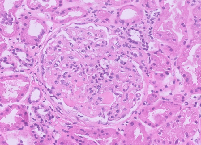 When is A Kidney Biopsy Indicated During the Treatment of Brain Cancer?