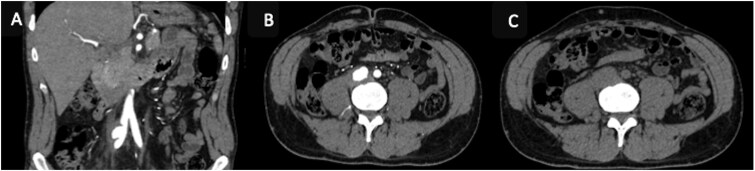 A rare etiology of right lower back pain in a young man: contained rupture of the common iliac artery aneurysm.