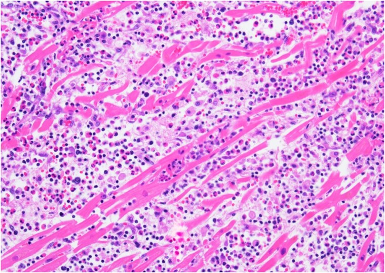 A case report of fulminant eosinophilic myo-pericarditis related to checkpoint inhibitors complicated by acute heart failure and cardiac tamponade.