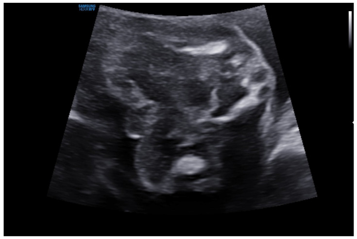 A Case Report of Tissue Mosaicism in 45,X0/46,XY: Diagnostic Complexity in a Newborn with Ambiguous Genitalia.