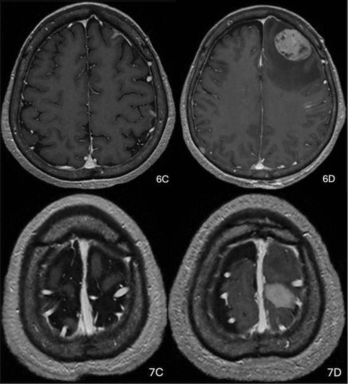 Primary Central Nervous System B-Cell Lymphoma Presenting with Fluctuating Basal Ganglia and Cortical Lesions.