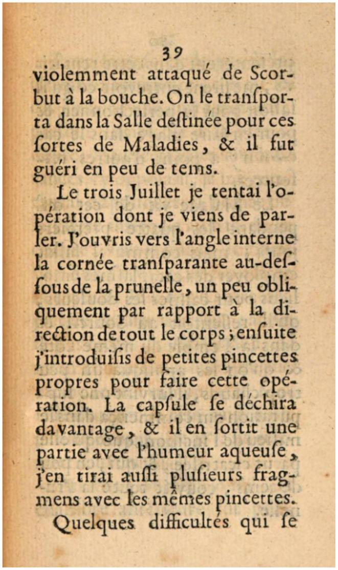 Jacques Daviel (1696-1762) and the Competition to Extract Cataracts: A Reappraisal.