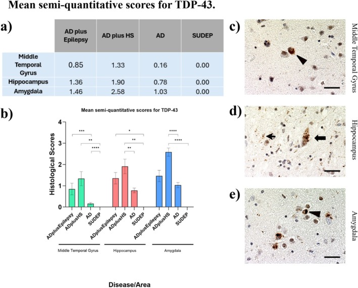 Increased Incidence of Epilepsy in a Brain Bank Alzheimer's Disease Cohort and Its Association With TDP-43 Pathology.