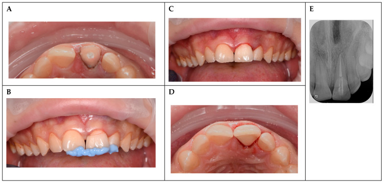 Management of a Complicated Crown Fracture in a 16-Year-Old Patient: A Case Report.
