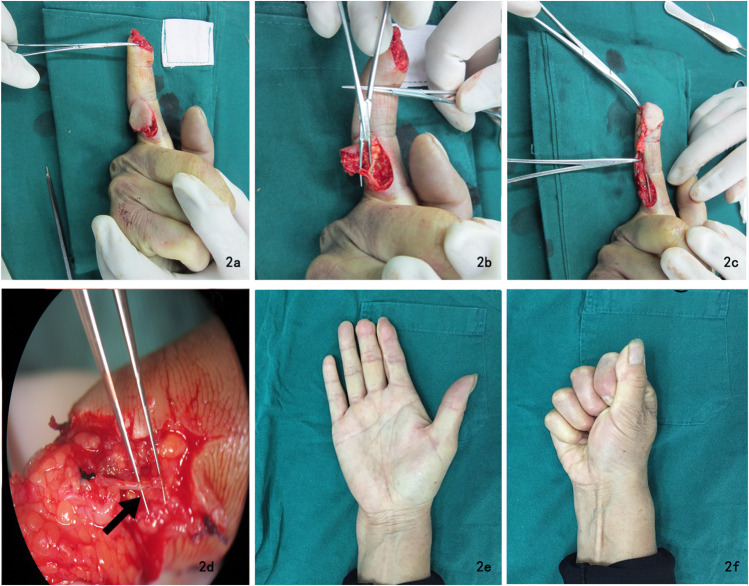 Similar Diameter of Cutaneous Branches of the Proper Digital Nerve and Stump of the Proper Palmar Digital Nerve was a Key Factor for the Sensory Reconstruction in Short Term Outcome of Finger Pulp Defects: A Retrospective Study.