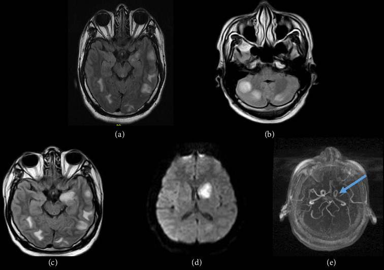 Paradoxical Reactions of Central Nervous System Tuberculosis: Report of Three Immunocompetent Cases.