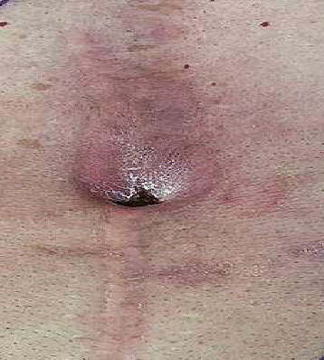 Gastrointestinal Fistulas-What Gastroenterologists Need to Know in 2025.
