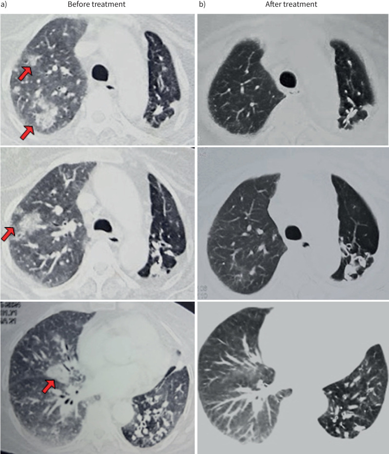 A 53-year-old woman with necrotising myopathy presenting with cough and respiratory distress: a diagnostic conundrum.