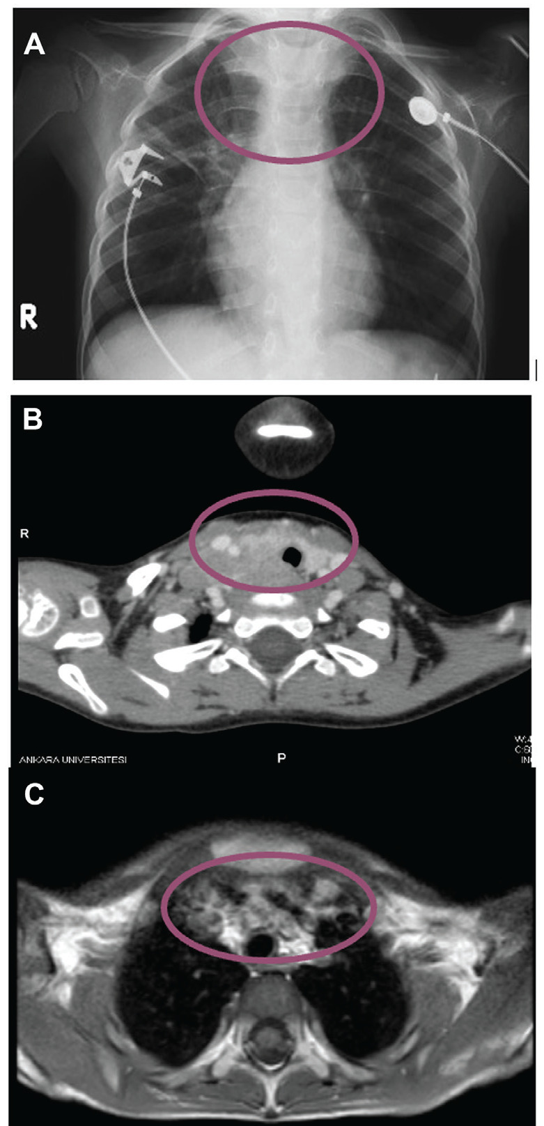 Familial Clinical Heterogeneity of Medullary Thyroid Cancer with Germline <i>RET</i> S891A Protooncogene Mutation: 7-year Follow-up with Successful Sorafenib Treatment