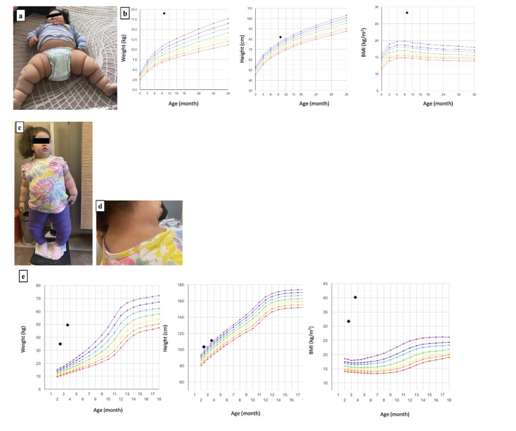A Rare Case of Monogenic Obesity Due to a Novel Variant in the <i>ADCY3</i> Gene: Challenges in Follow-up and Treatment