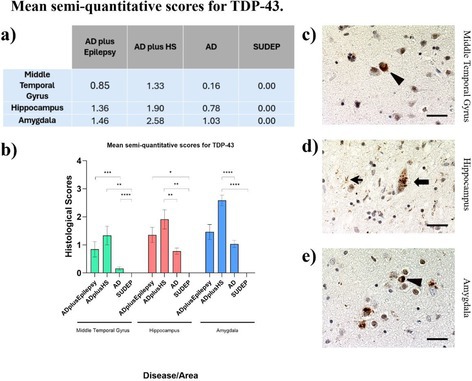 Increased Incidence of Epilepsy in a Brain Bank Alzheimer's Disease Cohort and Its Association With TDP-43 Pathology.