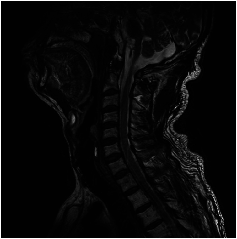 Misdiagnosis of supraclavicular brachial plexus metastasis as cervical disc herniation: A lung cancer case report.