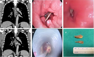 Airway Foreign Body-Leave Nothing Behind.