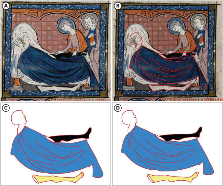 A Medical Error of Saints Cosmas and Damian: Reflections on Fallibility and Medical Education From a Medieval Miracle.