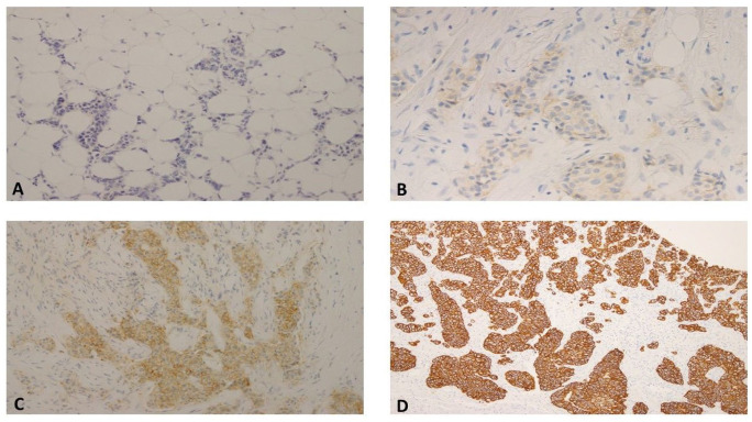 Human Epidermal Growth Factor Receptor 2-Low Breast Cancer: Prevalence Rate and Scoring Concordance Among Pathologists.