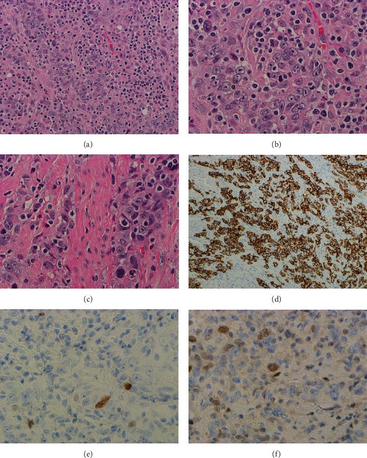 Simultaneous Lymphoepithelioma-Like and Plasmacytoid Subtypes of Urothelial Carcinoma, Along With Prostatic Adenocarcinoma With Clinical Follow-Up.