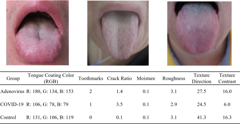 Tongue Image-Based Diagnosis of Acute Respiratory Tract Infection Using Machine Learning: Algorithm Development and Validation.