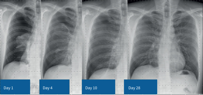 New strategies in the management of pneumothorax.