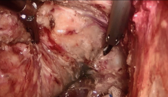 The impact of nano-carbon suspension lymph node tracing on rectal cancer surgery post-neoadjuvant therapy.