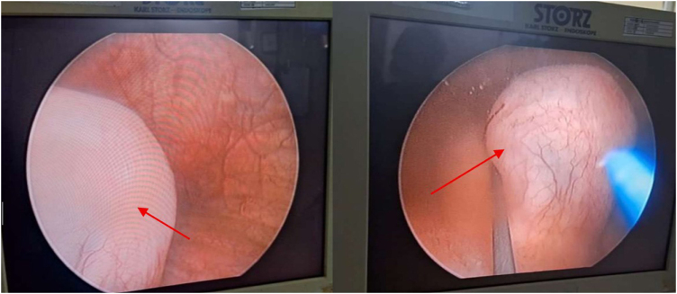 Endoscopic thulium-fiber laser deroofing and dual stenting for adult duplex ureterocele with preserved upper renal moiety: a case report.