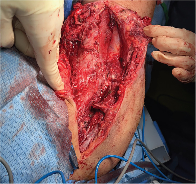 Promoting early detection of necrotizing soft tissue infection of the upper extremity in patients with history of breast cancer: a case report.