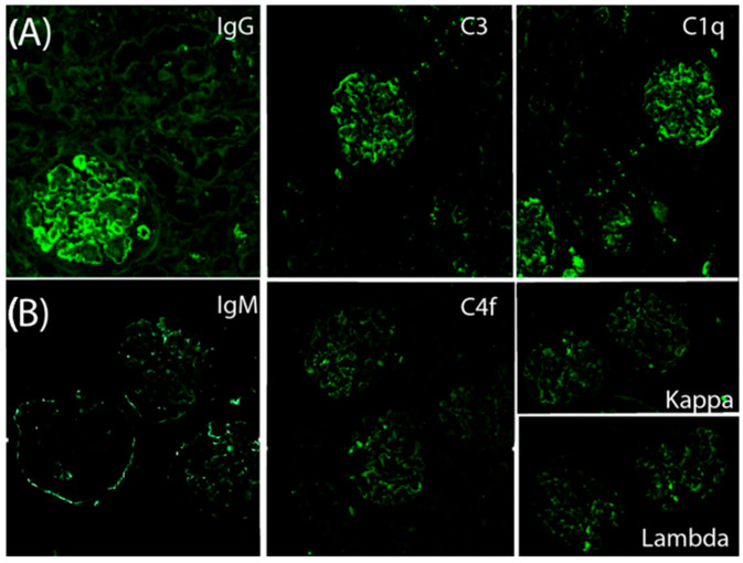 An Unusual Case of Membranoproliferative Glomerulonephritis: Is the Role of Vaccination in Immune Reactivation a Casual or Causal Effect?