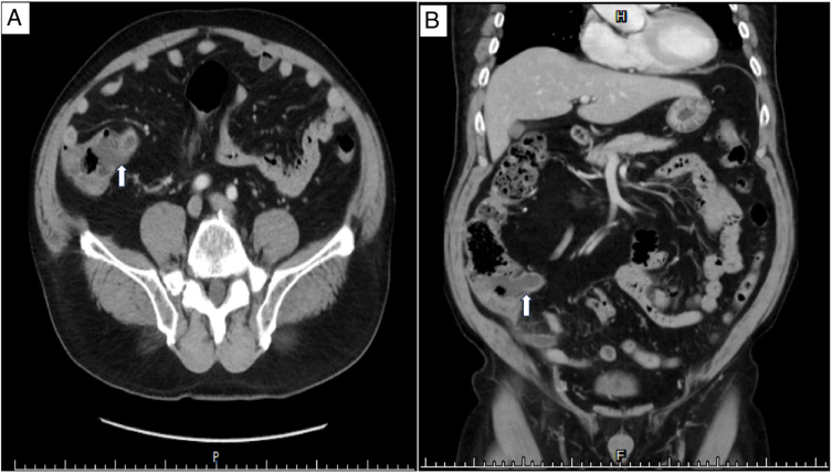 Primary signet ring cell carcinoma of the appendix presenting as gangrenous appendicitis with peritonitis: a case report.