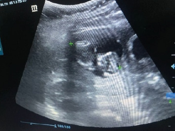 Hemorrhagic Shock in Primary Hepatic Pregnancy: A Diagnostic and Surgical Challenge.