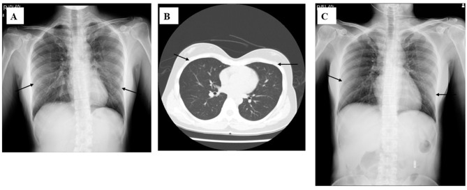 Adult Hospitalized Mycoplasma Cases in a Tertiary Hospital in Japan.