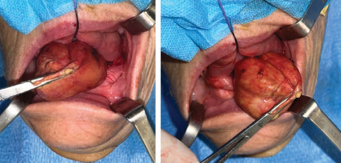 Oral Dermoid Cyst in the Mouth Floor: A Case Report and 5-Year Review of the Literature.