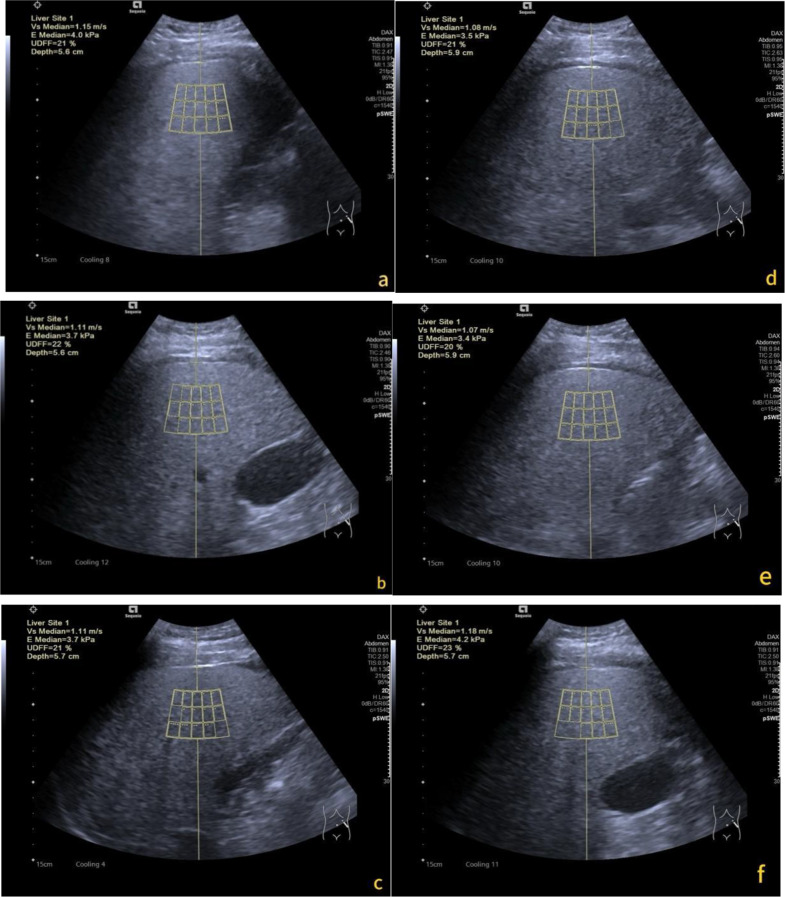 Consistency and reliability of ultrasound-derived fat fraction in hepatic steatosis assessment: influence of posture and breathing variations.