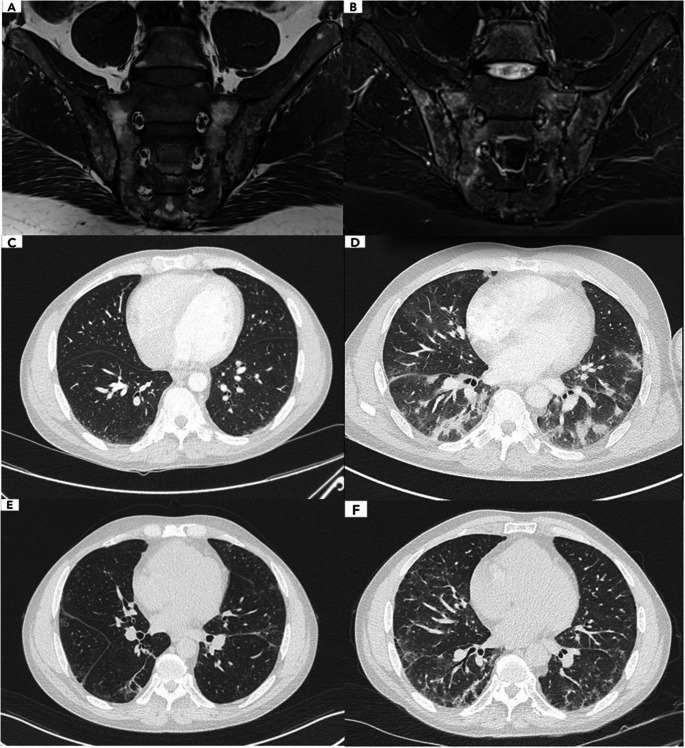 Antisynthetase Syndrome during anti-TNF-alpha Therapy: Report of Two Cases.