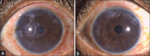Outcomes of DMEK without peripheral iridotomy and a review of the literature.