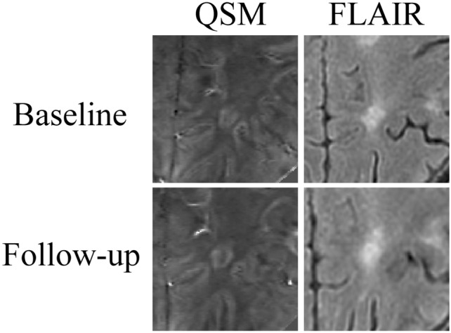 Paramagnetic rim lesions are associated with choroid plexus inflammation and expansion over 5 years in people with multiple sclerosis.