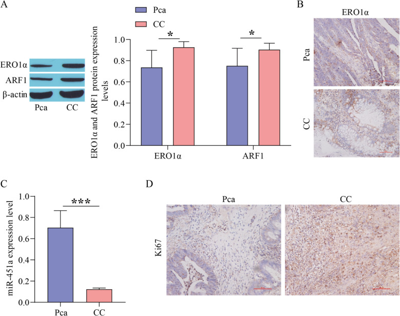 ERO1α regulates colon cancer progression and 5-FU resistance through the miR-451a/ARF1 axis.