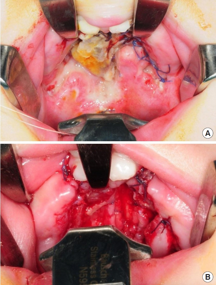 Familial predisposition to flap necrosis after palatoplasty: a case report of two siblings with bilateral cleft palate.