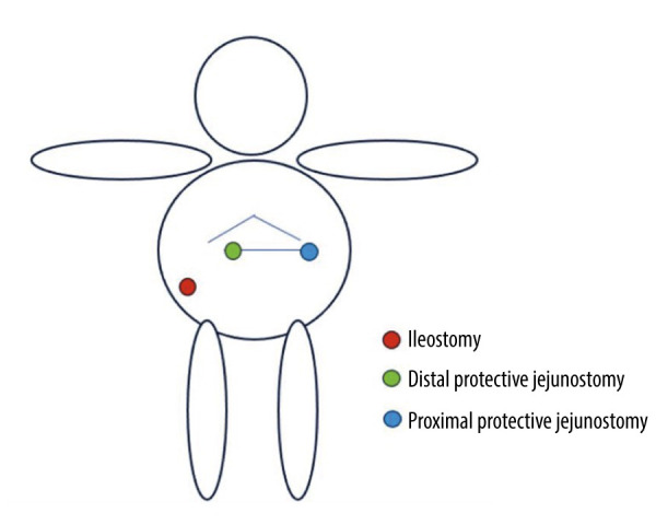 Optimal Closure Timing for Protective Jejunostomy in an Infant with Necrotizing Enterocolitis: A Case Report.