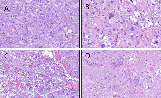 High-grade glioma with pleomorphic and pseudopapillary features: a single-institution series of three cases.