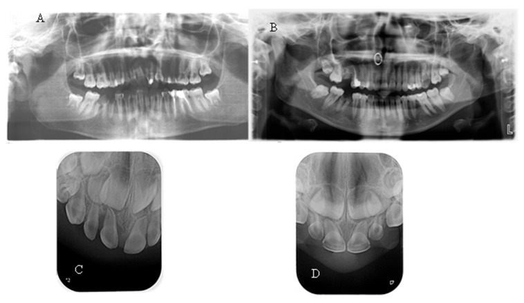 Oral Health Status and Parental Awareness in Children with X-Linked Hypophosphatemic Rickets: A Case-Control Study.