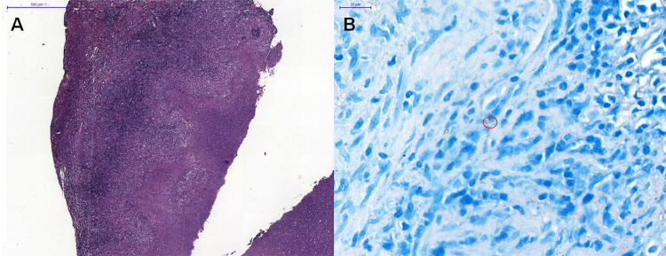 Behçet's disease and tuberculosis: unmasking infection behind a suspected flare.