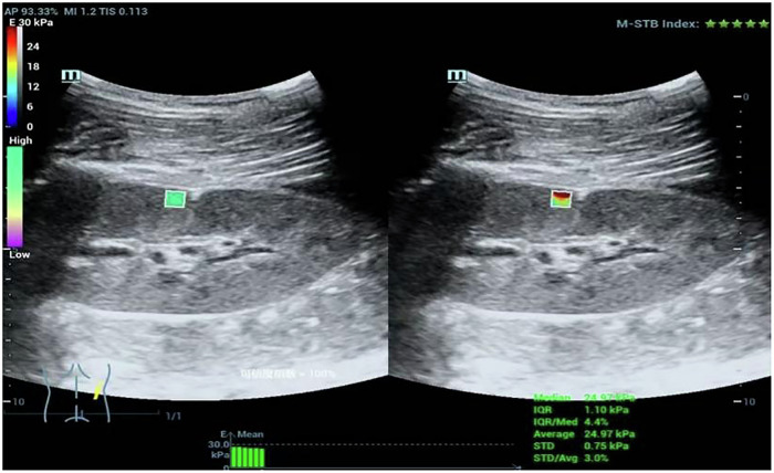 Shear wave elastography for assessing kidneys in pediatric patients with primary nephrotic syndrome.