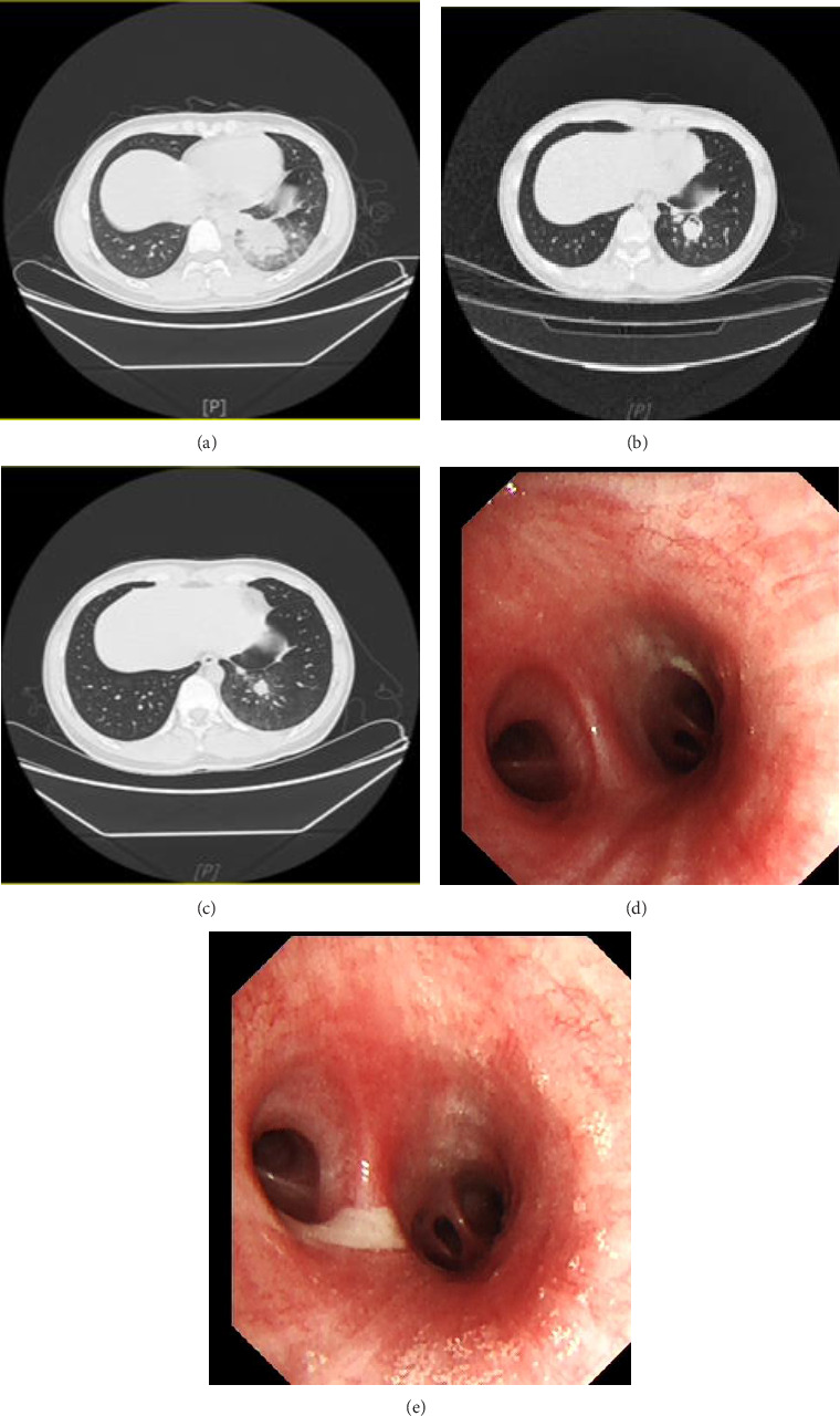Bronchoalveolar Lavages Combined With Glucocorticoids in Management of Acute Exogenous Lipoid Pneumonia: 3 Case Reports.