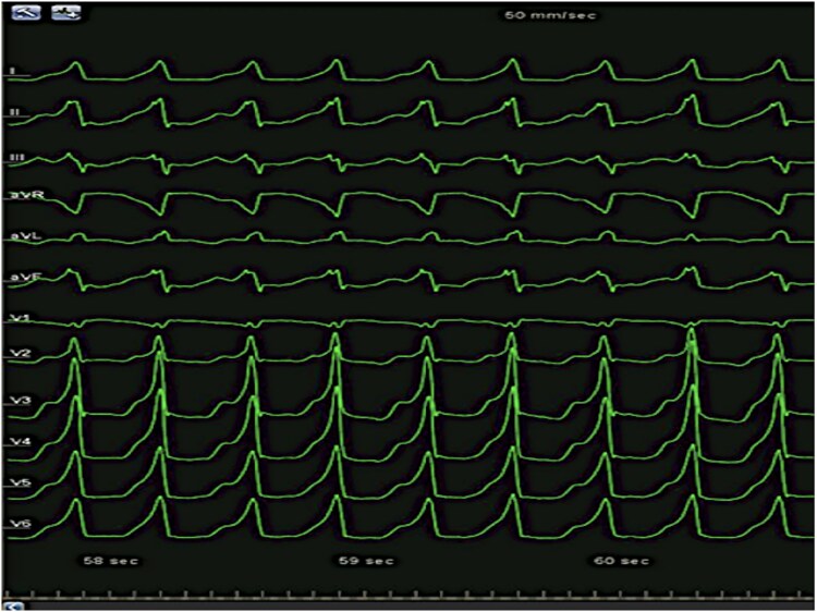 Ablation of ventricular tachycardia originating from the lower and septal portion of aortic prosthesis following transcatheter aortic valve replacement: a case report.