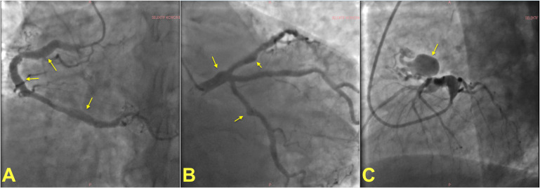 Pathophysiology, Diagnosis, and Management of Coronary Artery Aneurysms: A Review.