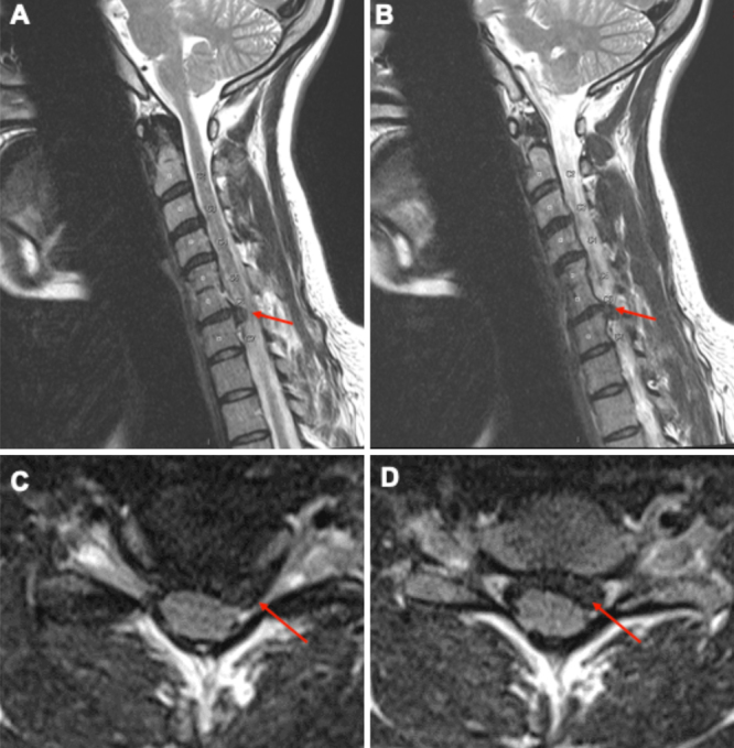 Multidisciplinary management of cervical disc herniation in pregnancy: illustrative case.
