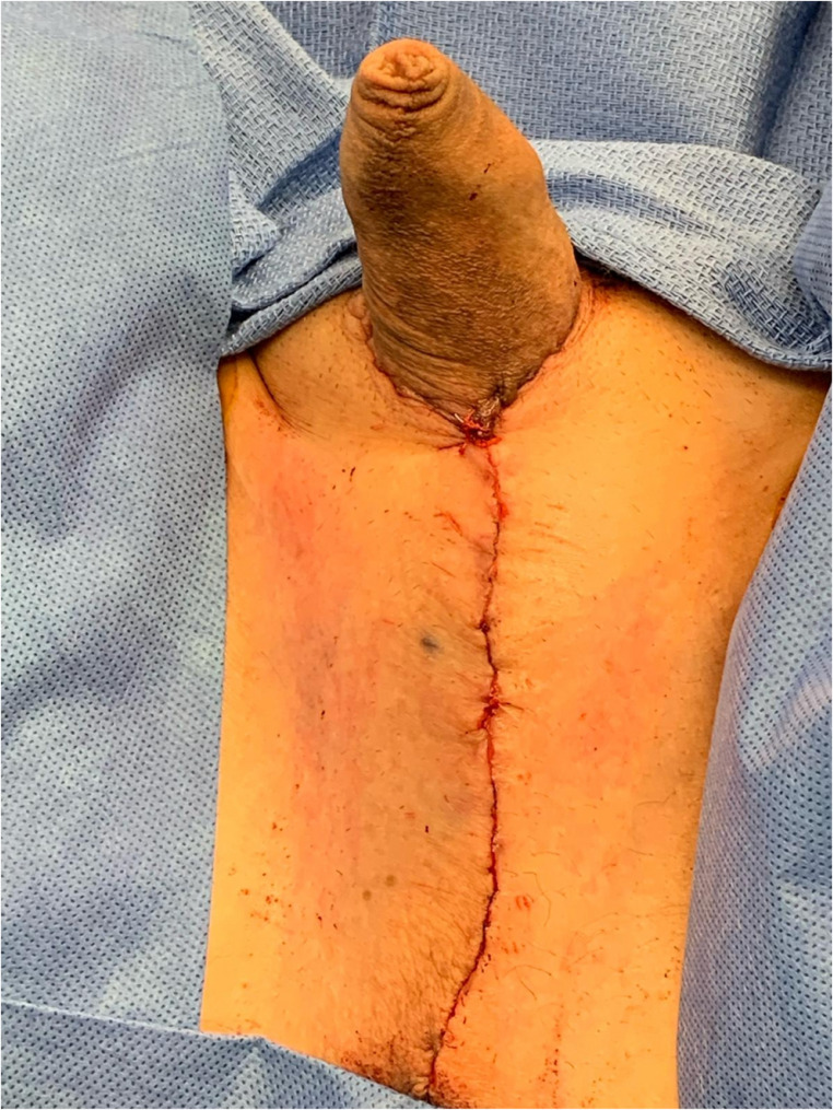 Orchiectomy and scrotectomy as genital gender-affirming surgery: novel surgical technique and patient-reported outcomes.