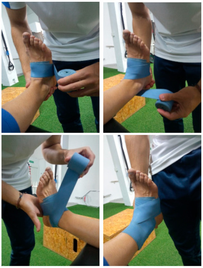 Effectiveness of a Flossing Protocol and Manual Therapy in Improving the Clinical and Functional Status of Subjects with Recurrent Ankle Sprains; A Double-Blind Randomized Clinical Trial.