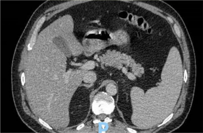 Rapid Metastatic Growth of A Pancreatic Signet Ring Cell Carcinoma within 6 weeks of A Negative CT.