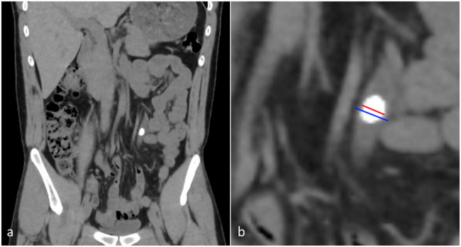 Can the degree of ureteral stone impaction better predict surgical success and complications? a new classification system.