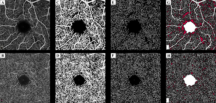 The Importance of Matching Optical Coherence Tomography Angiography Metrics to Diabetic Retinopathy Severity for Detecting Progression.